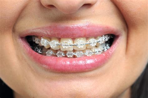 metal and ceramic brackets|ceramic braces before and after.